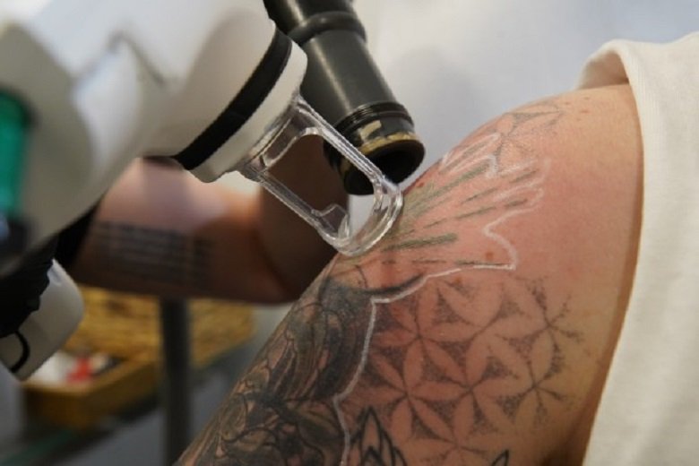 Laser Tattoo Removal Dubai: Step-by-Step Treatment Guide
